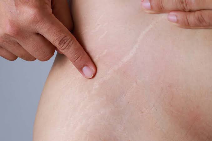 Hilangkan Stretch Mark secara alami, images: Jovee